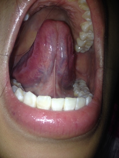 舌下腺有溃疡糜烂图图片