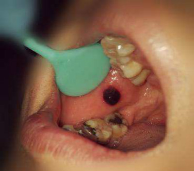 口腔上颚癌早期图片图片