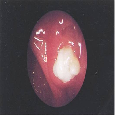 扁桃体肿瘤早期症状图片