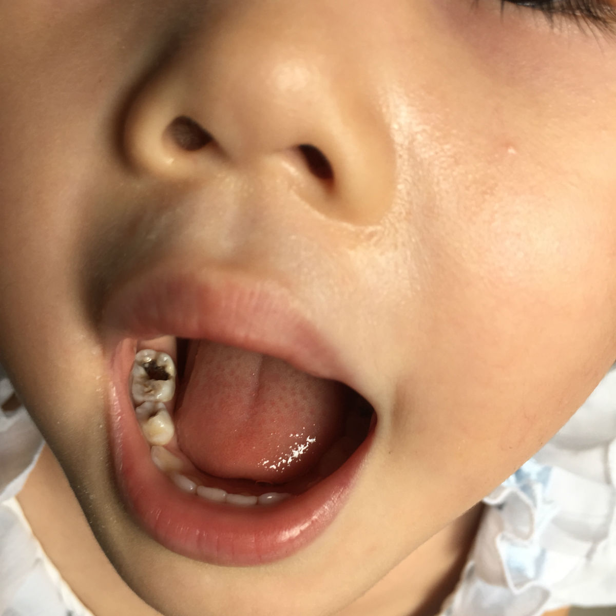 儿童梅毒牙齿图片-图库-五毛网
