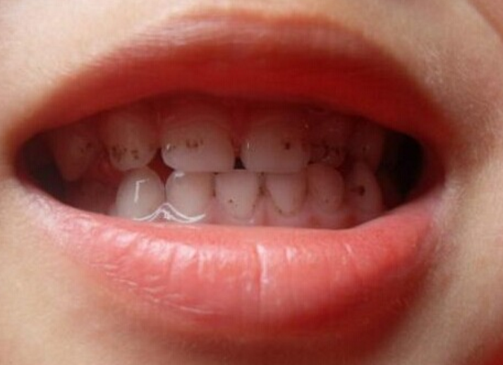 小孩子牙齿发黑图片