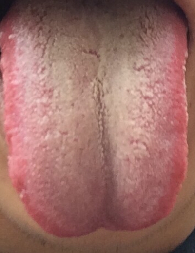 艾滋病舌头图片 (10)