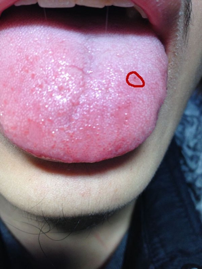 艾滋病舌头长肉芽图片图片