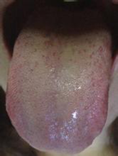 艾滋病舌头图片 (62)