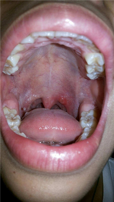 正常喉咙滤泡图片图片