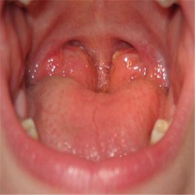 正常咽喉滤泡增生图片图片