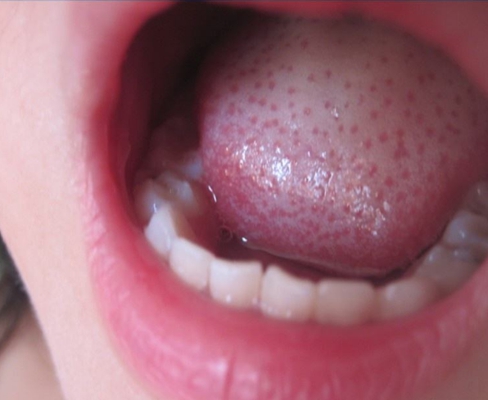舌根淋巴瘤图片图片