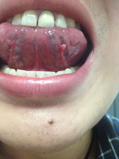 舌头下长肉芽图片 (2)
