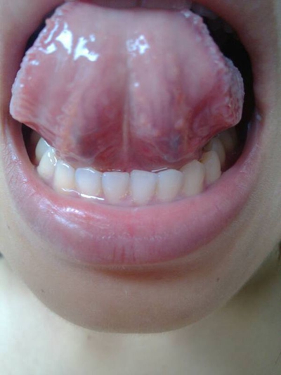 舌头下长肉芽图片 (2)