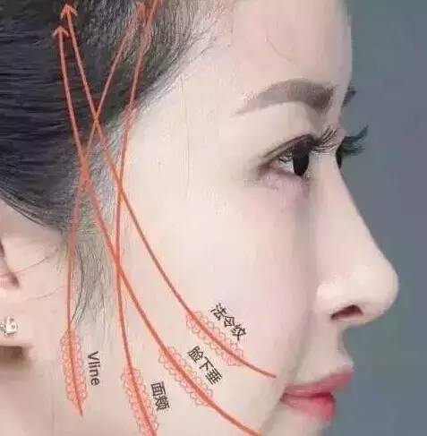 面部提升,年轻10岁不是梦!