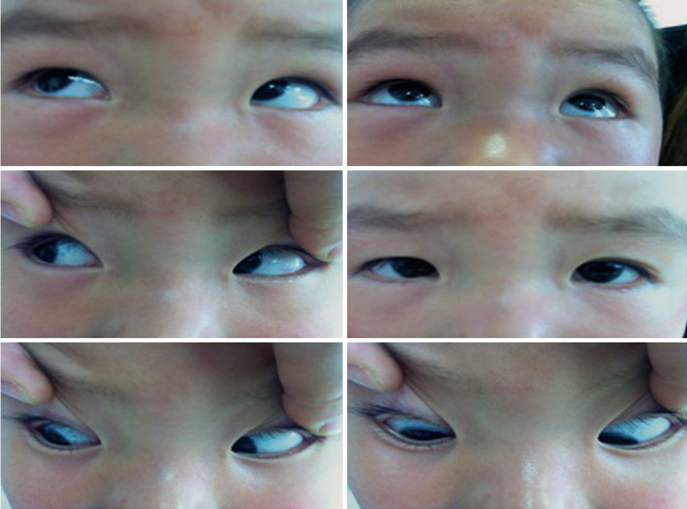 这几种眼病，可能会遗传给下一代|先天性|儿童|近视|斜视|青光眼|-健康界