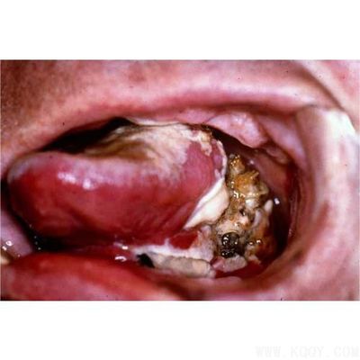 良性口腔肿瘤症状图片图片