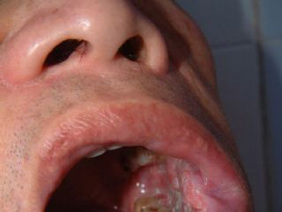 上颚癌早期症状口腔癌图片