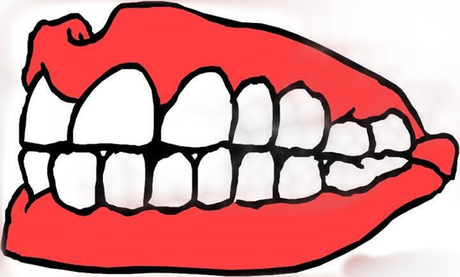 牙龈瘤 (2)