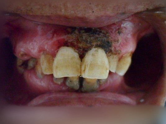 牙龈瘤 (14)