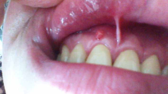 牙龈感染Hpv图图片