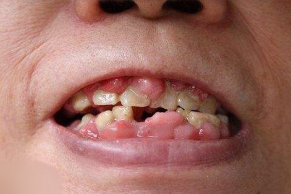 牙龈瘤 (43)
