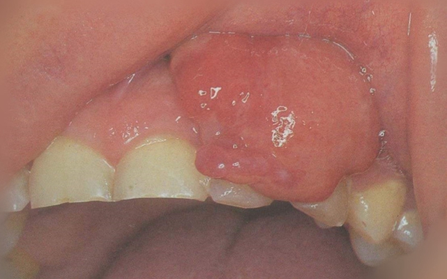 牙龈瘤 (46)