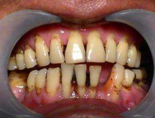 牙龈瘤 (49)