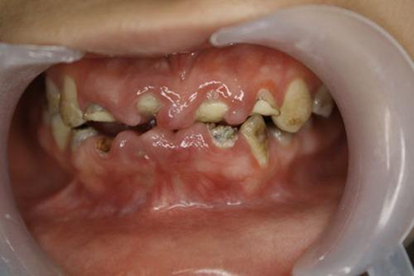 孩子牙瘤图片图片
