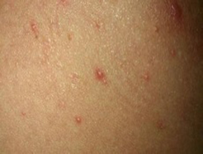 结节性痒疹 (37)