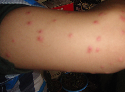 结节性痒疹 (4)