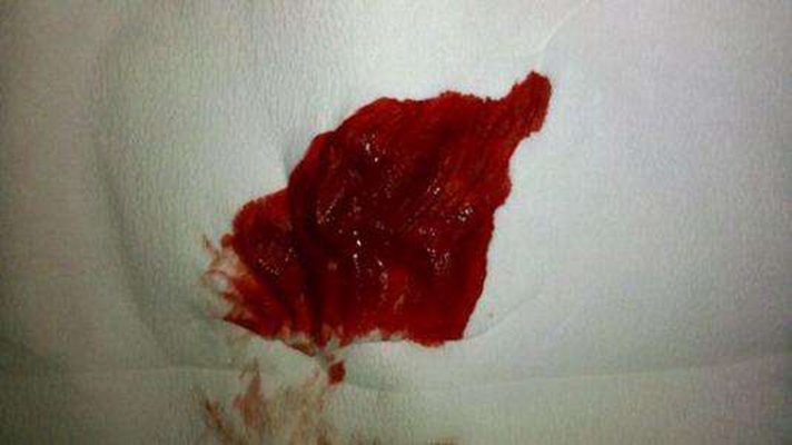 胃出血吐血照片图片
