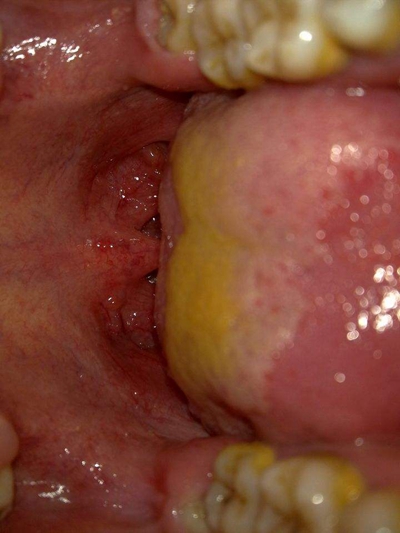 咽部充血严重图片图片