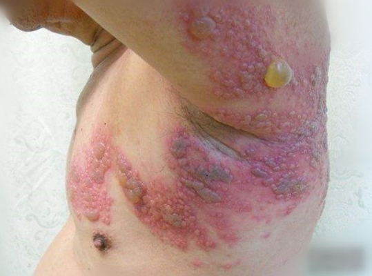 女性疱疹症状图片图片