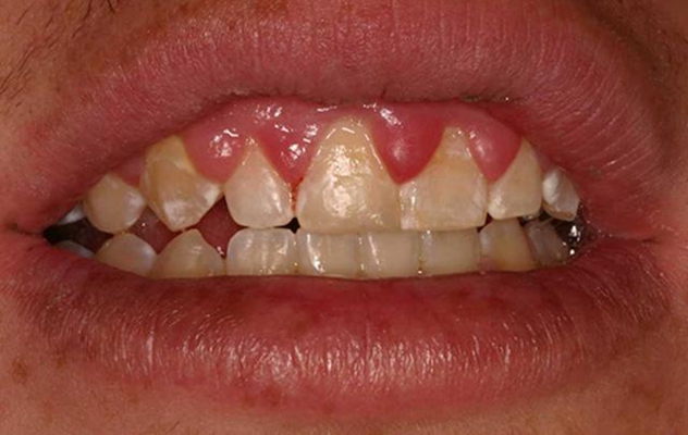 牙龈瘤 (12)