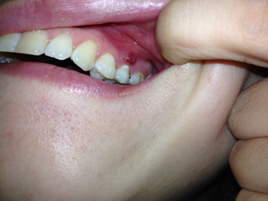 牙龈癌 初期图片