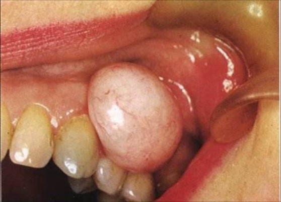 牙龈瘤 (47)