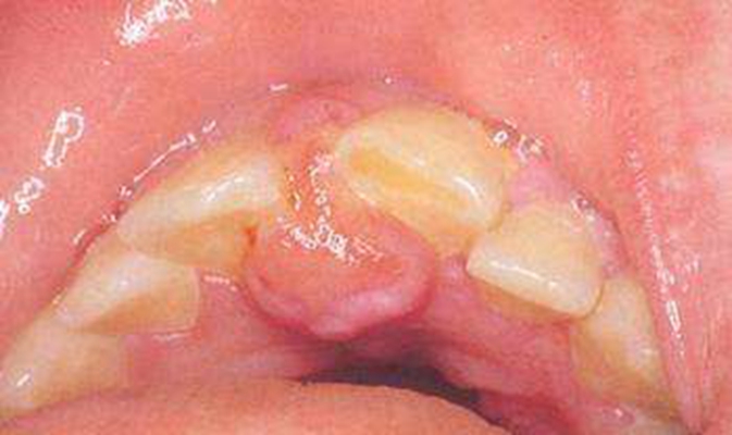 牙龈瘤 (44)