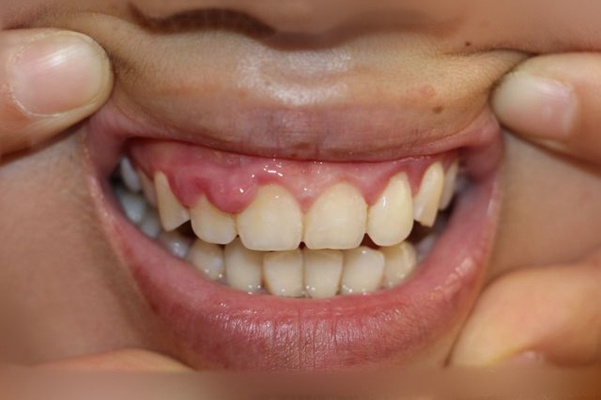 牙龈瘤 (5)