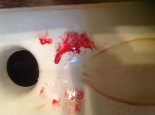 洗手池吐血图片图片