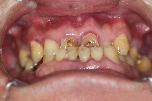牙龈瘘管压迫图片