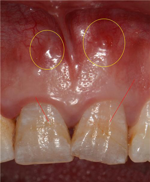 口腔瘘管的症状图片图片