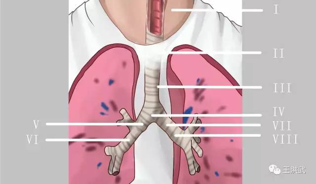 女士感到气促再次加重,到当地医院行气管镜示:左主支气管狭窄明显加重