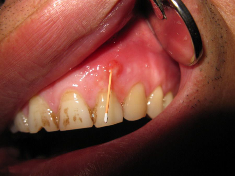 牙龈瘘管早期图片