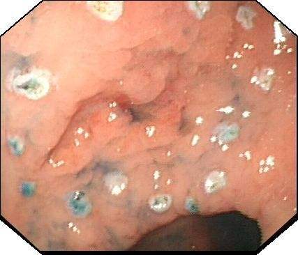 胃窦糜烂 (8)