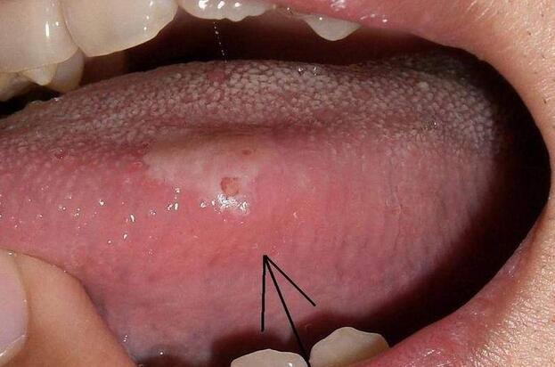 舌癌晚期的图片和症状图片