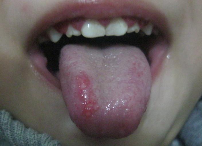 舌癌颗粒状肉芽图片图片
