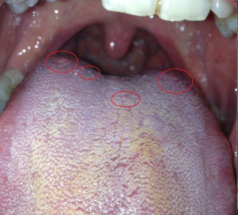 舌癌的症状图片舌头图片