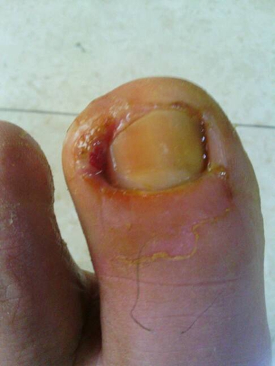 大脚趾指甲缝疼图片