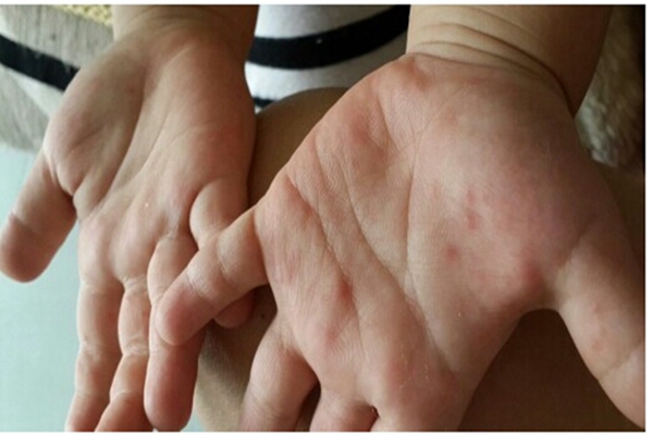 手足口病初期症状图片及治疗法(58)
