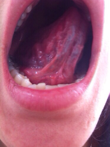 舌头上hpv感染图片图片