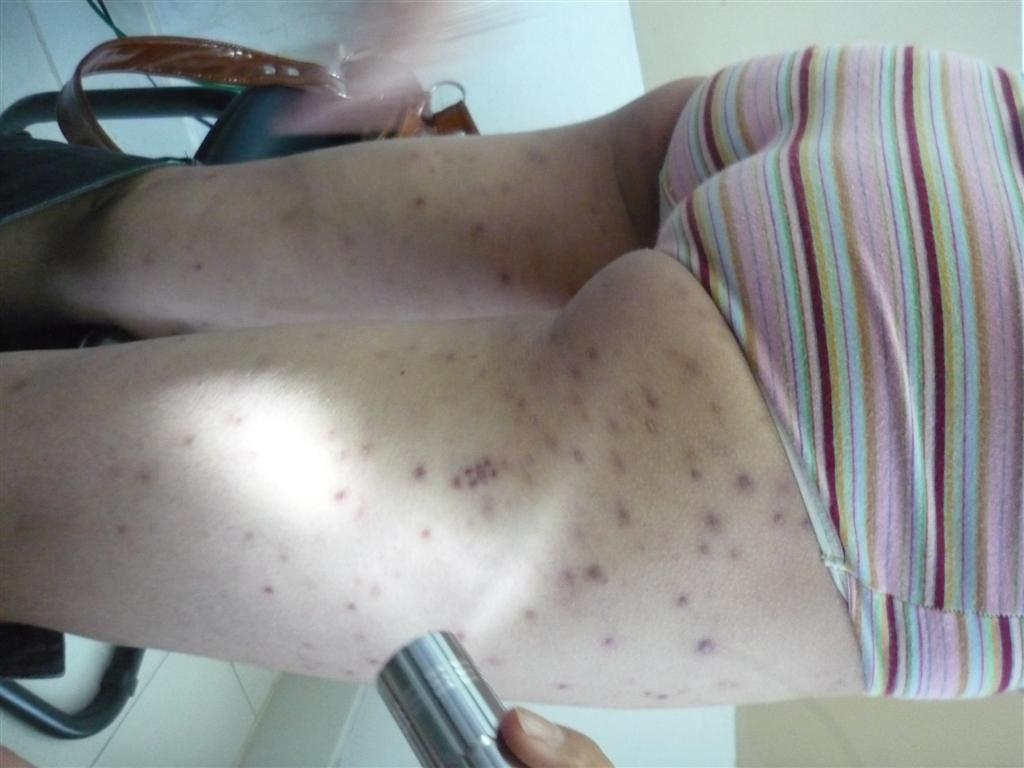 女性梅毒疹图片 一期图片