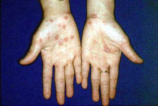 三期梅毒疹图片
