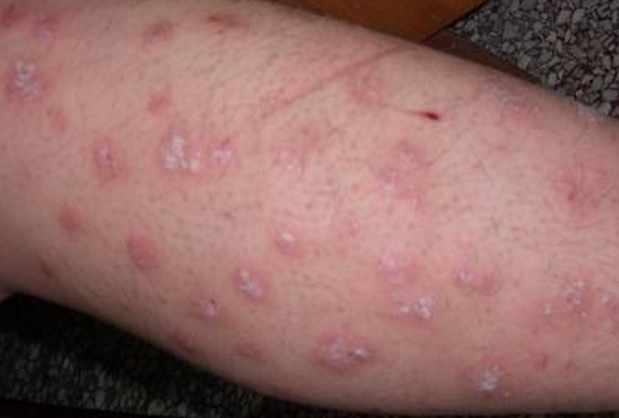 癣菌疹的症状图片图片