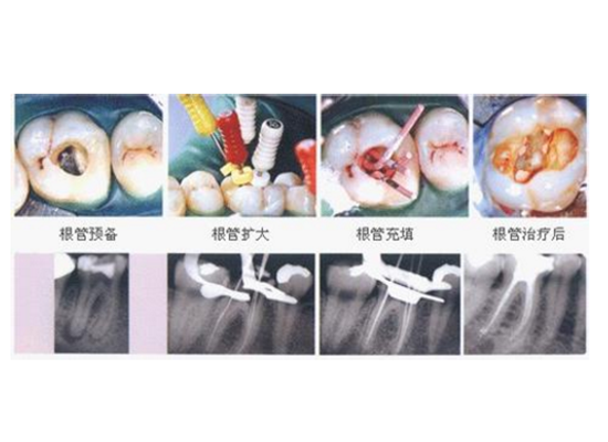 牙齿根管治疗 (6)